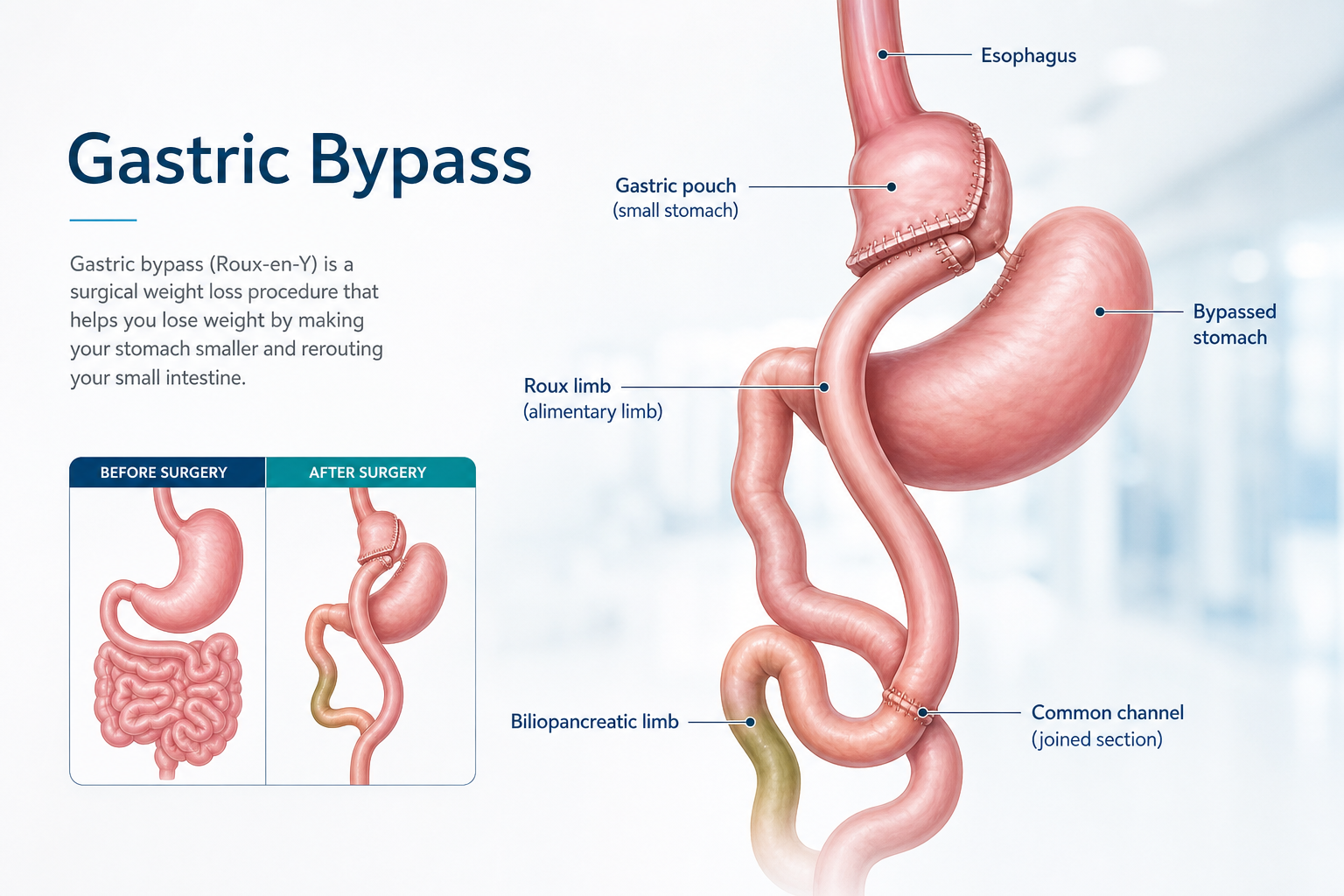 Gastric Bypass (Roux-en-Y)