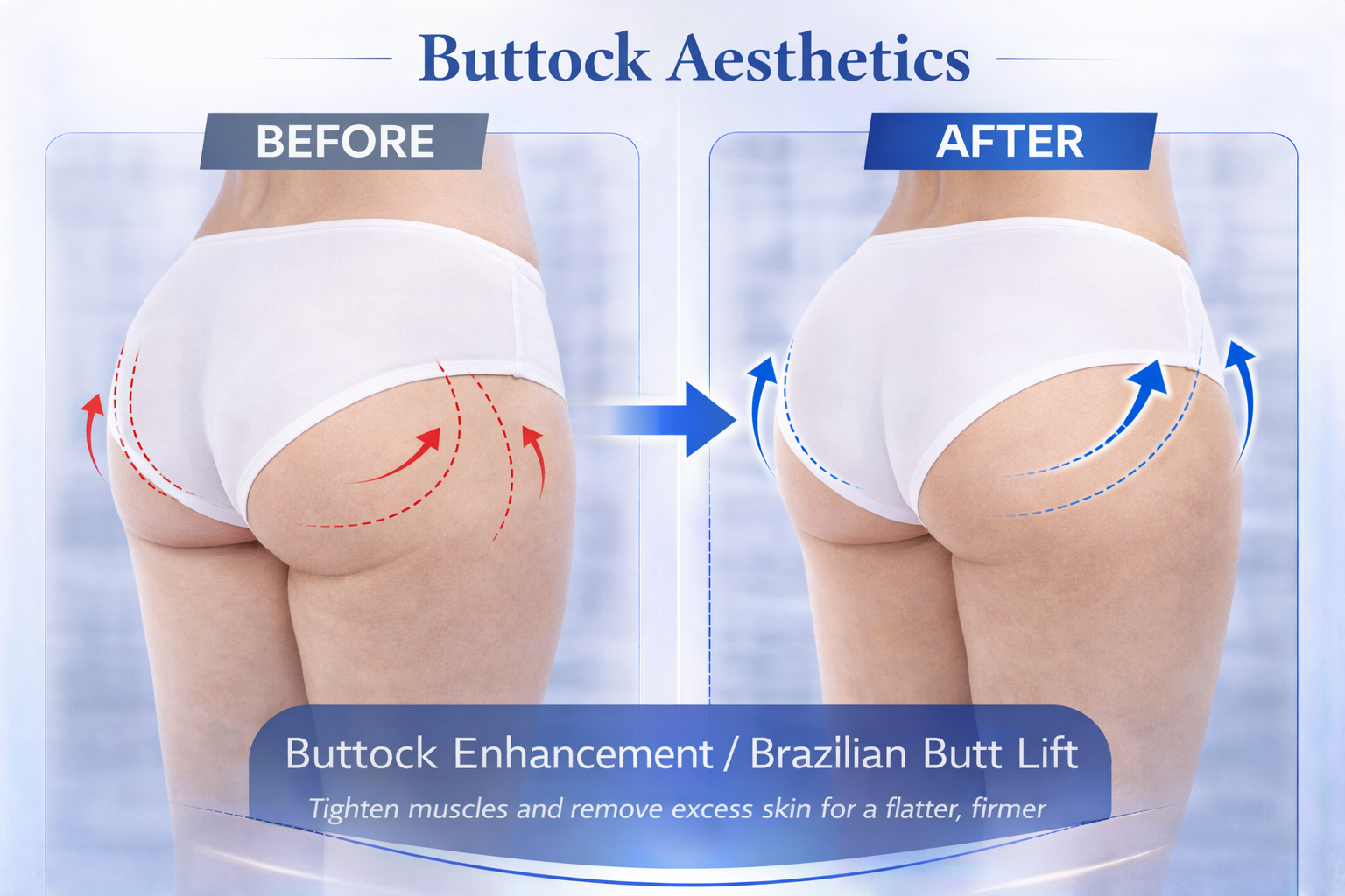Buttock Aesthetics Result