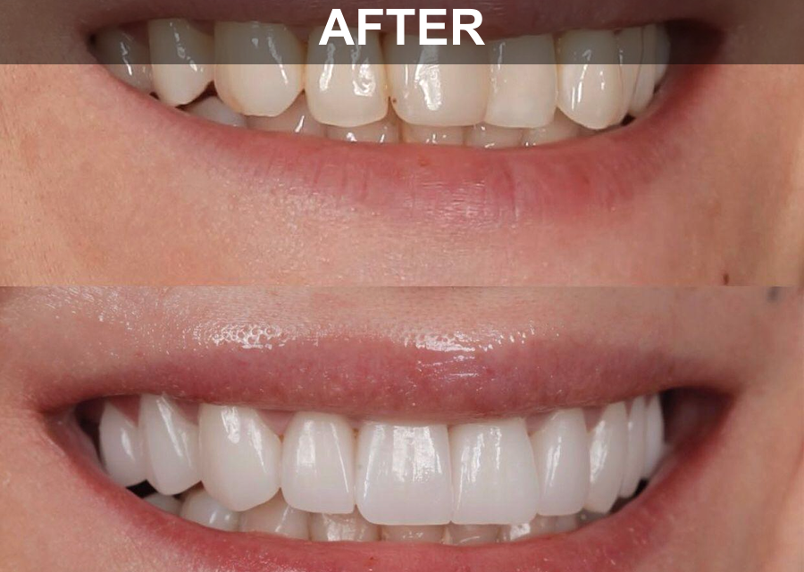 Full Ceramic